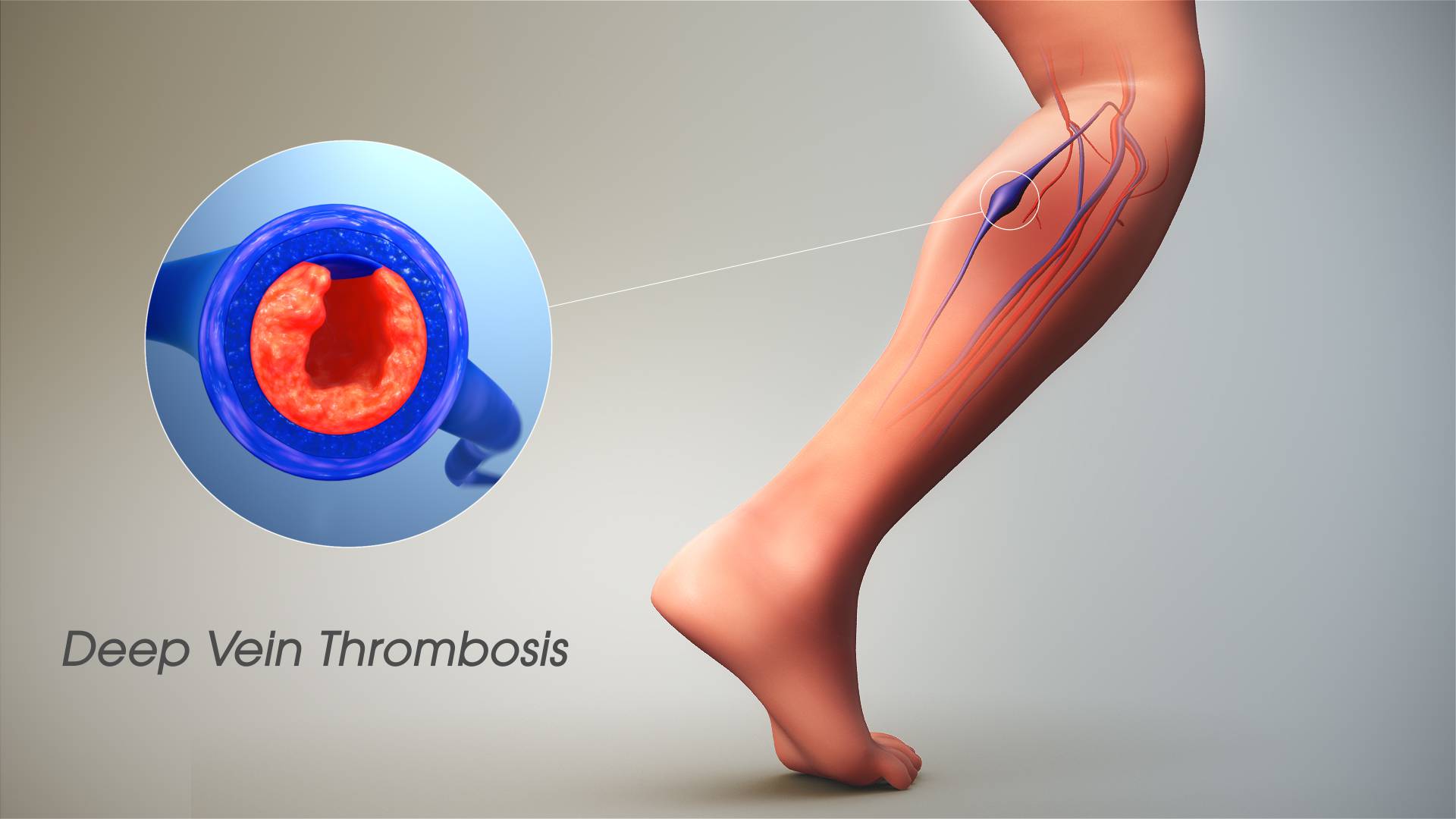 deep vein thrombosis symptoms leg