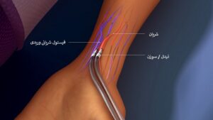 فیستول دیالیز