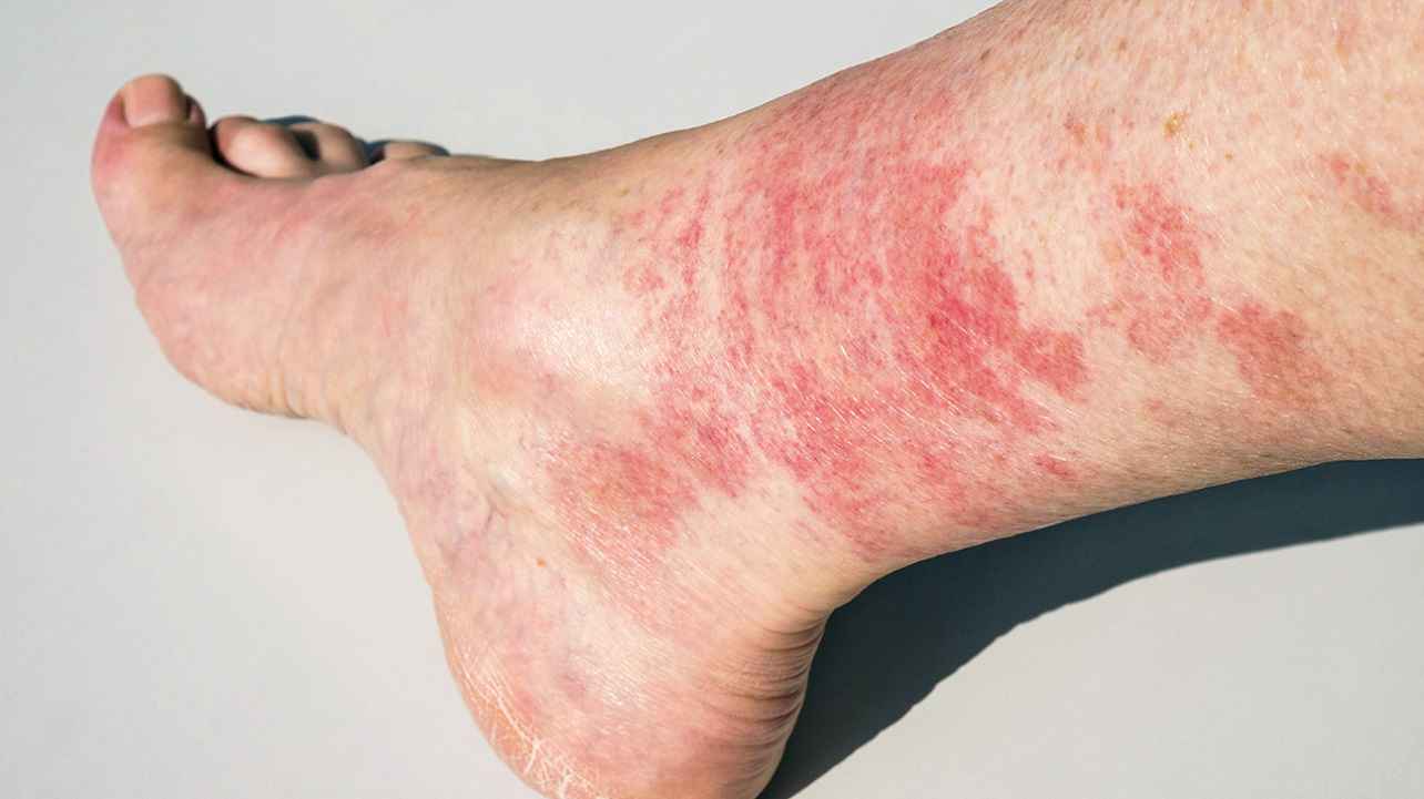 Red Blotches On Ankles And Lower Legs