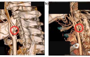 عوارض بعد از عمل کاروتید بادی عوارض بعد از عمل کاروتید بادی