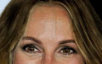 بیرون زدگی رگ پیشانی