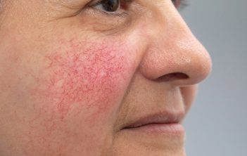 وریدهای روی صورت