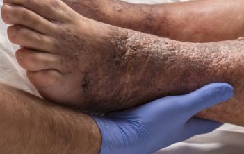 علت سیاه شدن پوست پا