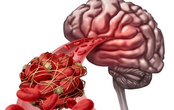 چگونه لخته خون در مغز را از بین ببریم