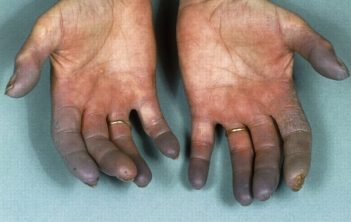 بیماری برگر