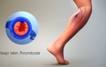 چگونه لخته خون را از بین ببریم