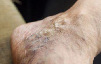 درمان ترومبوفلبیت سطحی