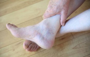 بیماری واریس در مردان