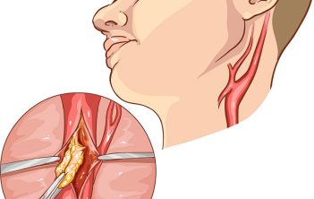 When does carotid artery occlusion require surgery