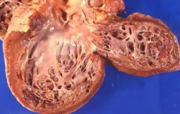 پاراگانگلیوما