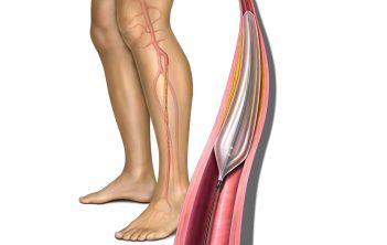 درمان گرفتگی عروق پا با آنژیوپلاستی