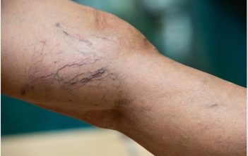 علت متورم شدن رگ پاها