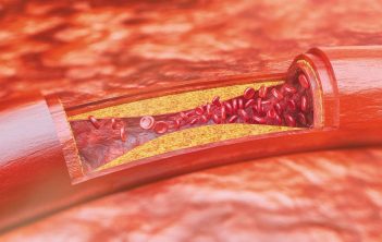 گرفتگی رگ قلب