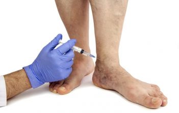 اسکلروتراپی واریس