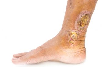 درمان زخم های وریدی